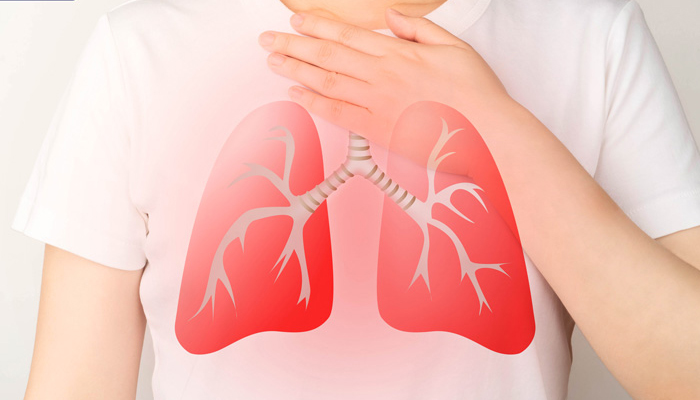 Bệnh viêm phổi là gì? Triệu chứng, nguyên nhân và cách điều trị